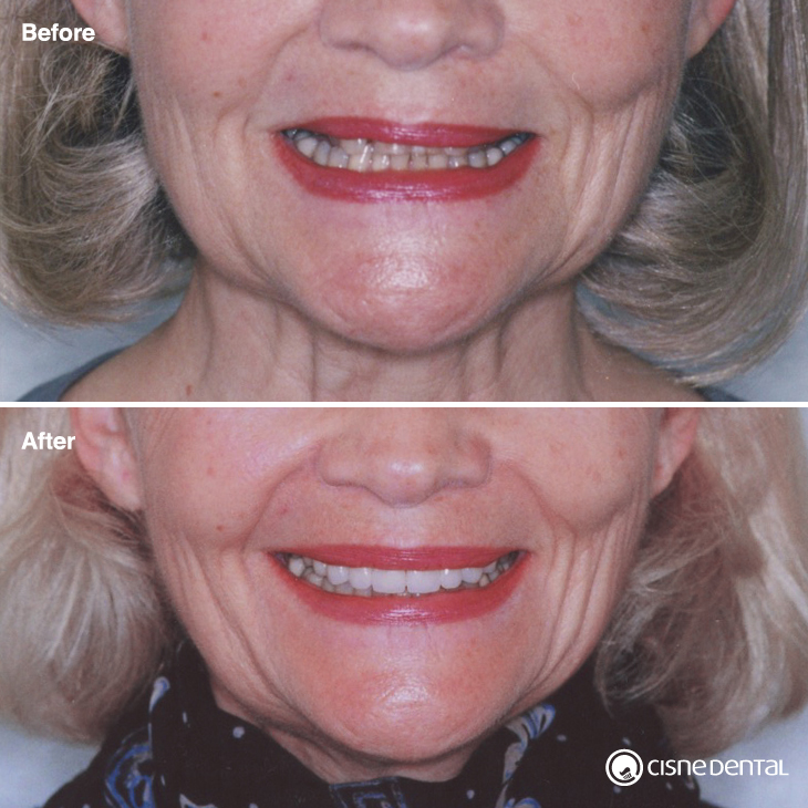 Dental orthodontics on a elderly woman combined with estetic porcelain on upper teeth and teeth whitening carried out by Cisne Dental Clinic in Madrid