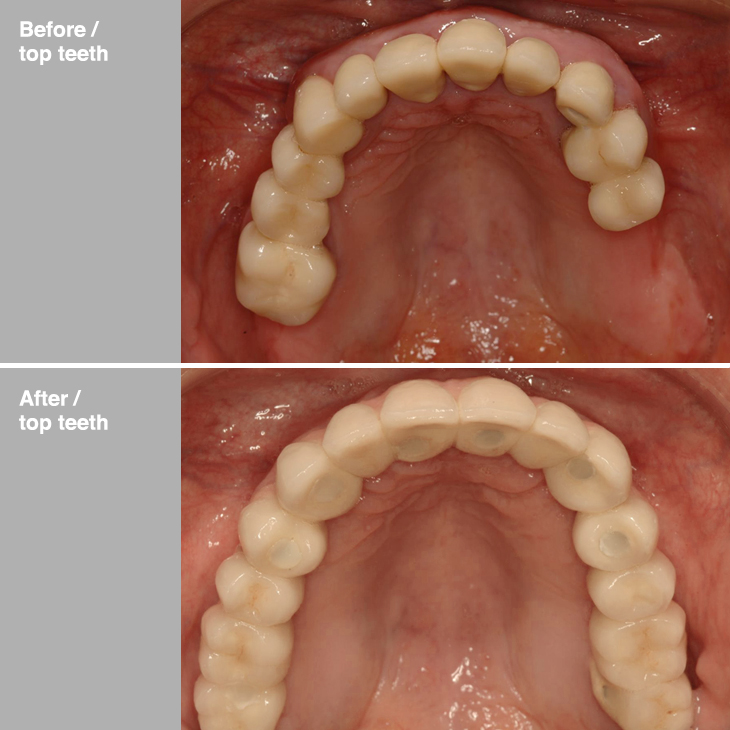 Straumman dental implants on an adult carried out by  Cisne Dental Clinic in Madrid