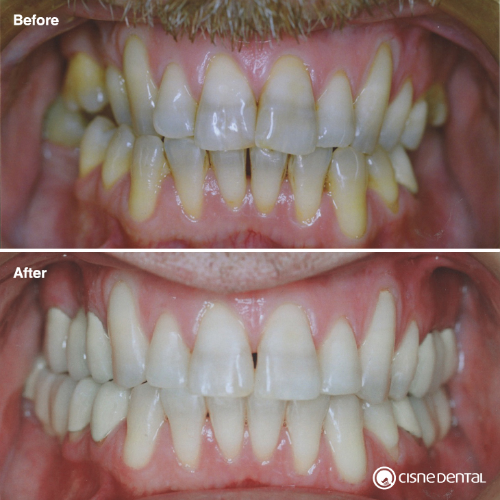 Orthodontics and dental implants combined with laser teeth whitening on an adult carried out by Cisne Dental Clinic in Madrid